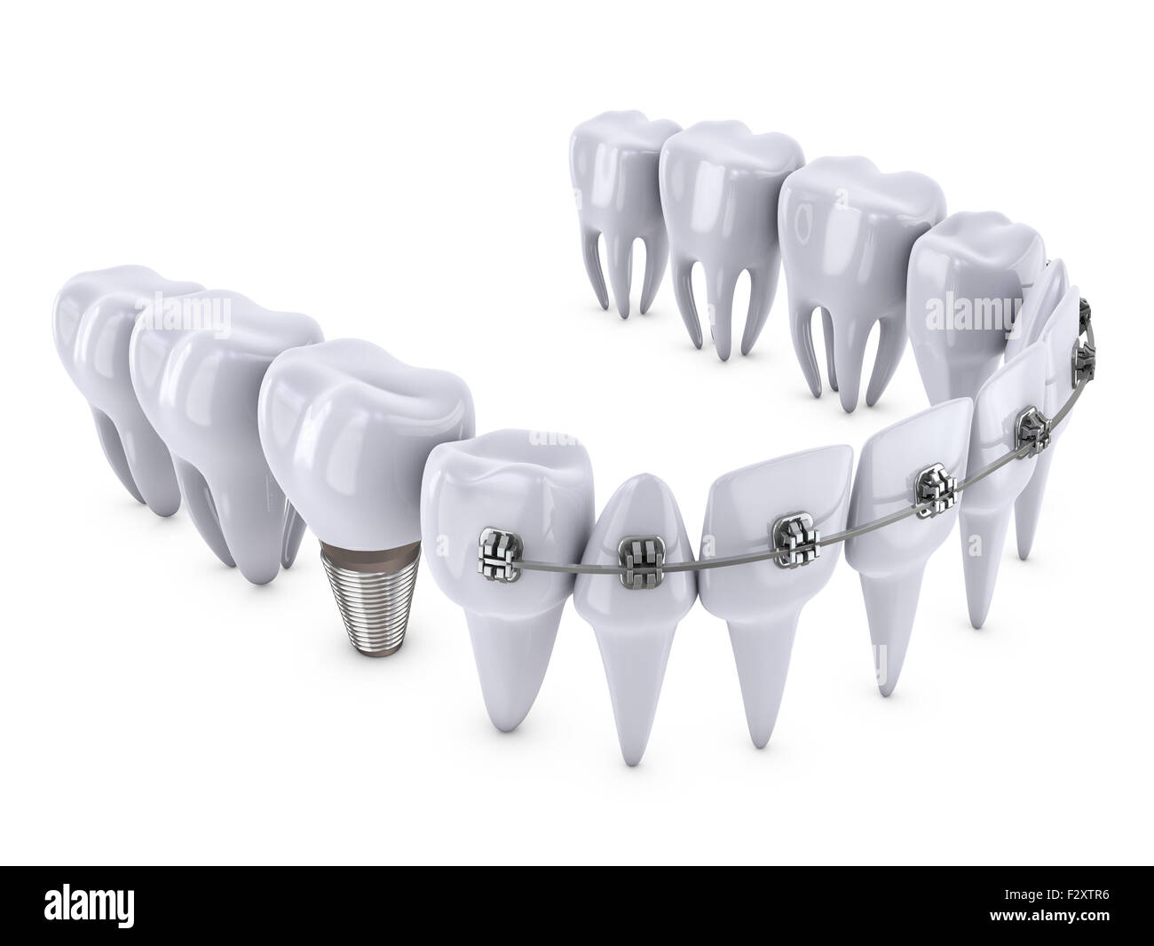 a teeth with braces and dental implants Stock Photo - Alamy