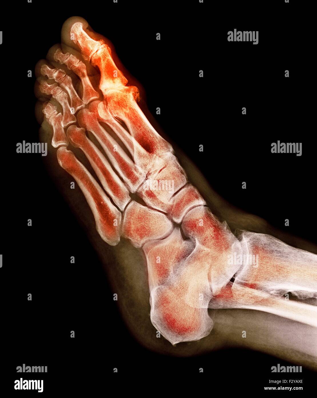 Foot bones x rays High Resolution Stock Photography and Images Alamy