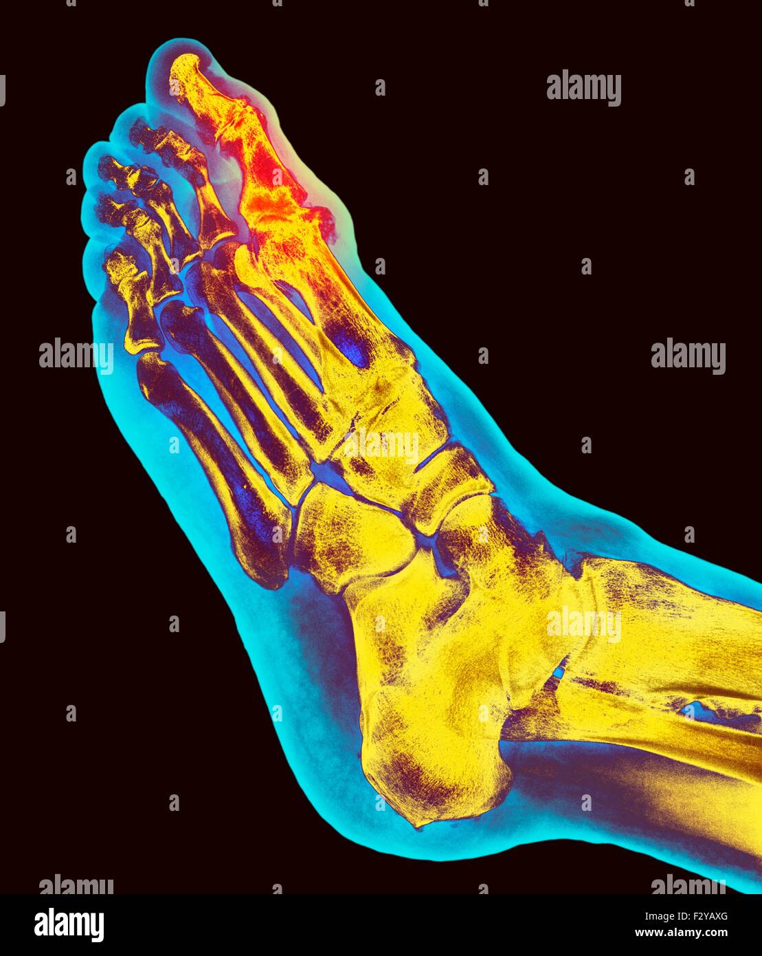 Toe deformation hires stock photography and images Alamy