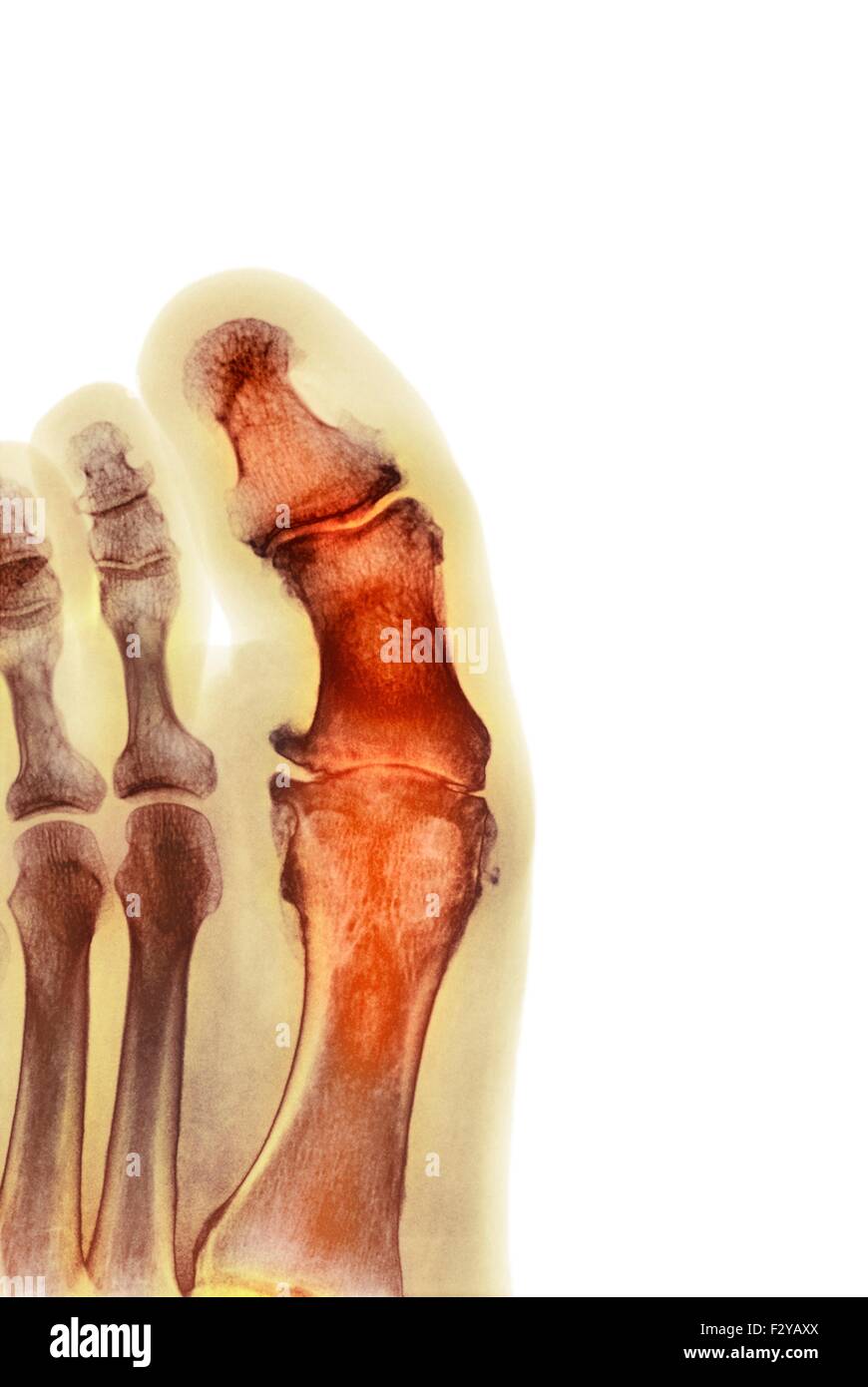 Degenerative Foot Deformation Coloured X Ray Of A Section Through The