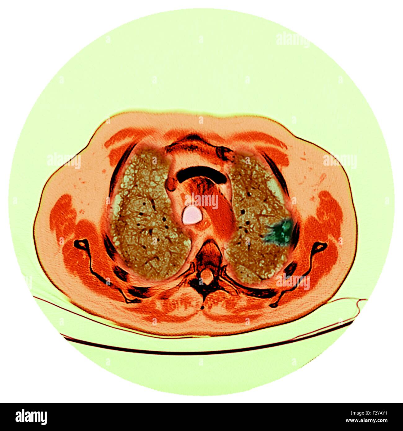 Lung cancer. Coloured computed tomography (CT) scan of a section through the chest of a 76-year-old male patient with a malignant (cancerous) tumour (dark, right) of the bronchus. The bronchi are the airways that carry air to the lungs and mouth. Stock Photo
