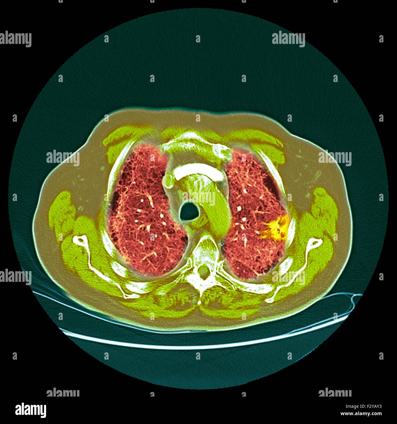 Lung cancer. Coloured computed tomography (CT) scan of a section through the chest of a 76-year-old male patient with a malignant (cancerous) tumour (bright, right) of the bronchus. The bronchi are the airways that carry air to the lungs and mouth. Stock Photo