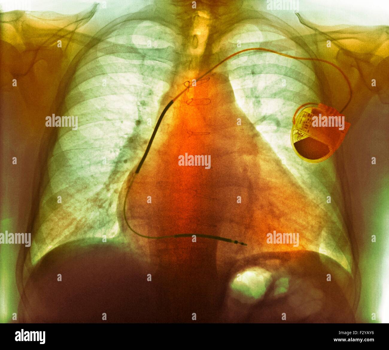 Pacemaker in heart disease. Coloured chest X-ray showing a pacemaker (right) fitted to a 73-year-old male patient with an enlarged heart (cardiomegaly) atrial fibrillation, ischaemic heart disease and chronic obstructive pulmonary disease (COPD). A pacemaker supplies electrical impulses to the heart to maintain the heartbeat at a regular rate. It may be external (worn on a belt) or internal (implanted in the chest, as here). Stock Photo