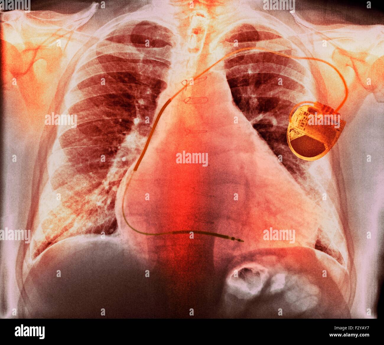 Pacemaker in heart disease. Coloured chest X-ray showing a pacemaker (right) fitted to a 73-year-old male patient with an enlarged heart (cardiomegaly) atrial fibrillation, ischaemic heart disease and chronic obstructive pulmonary disease (COPD). A pacemaker supplies electrical impulses to the heart to maintain the heartbeat at a regular rate. It may be external (worn on a belt) or internal (implanted in the chest, as here). Stock Photo