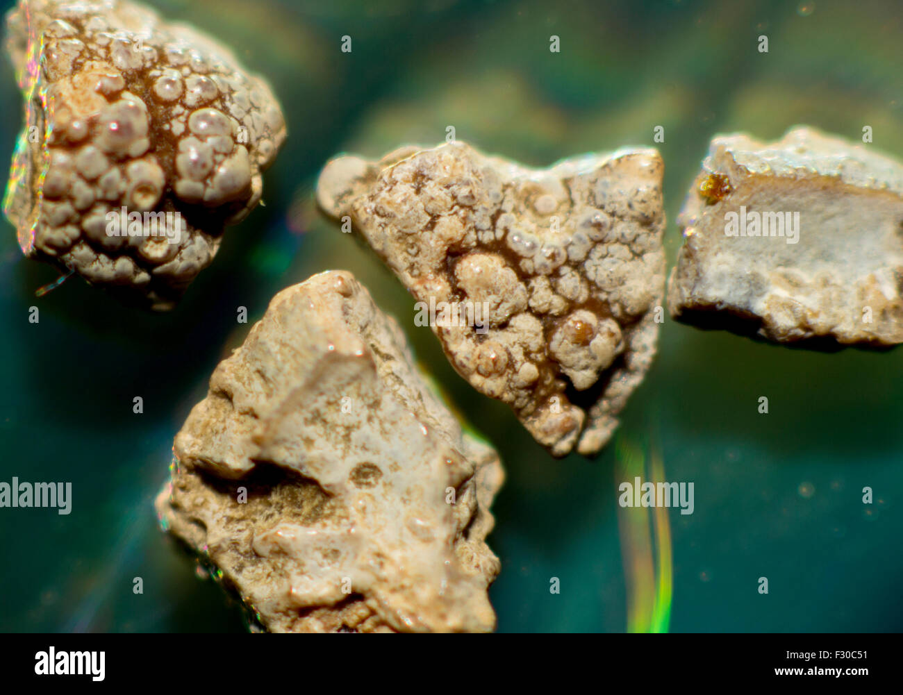 Kidney stone hires stock photography and images Alamy
