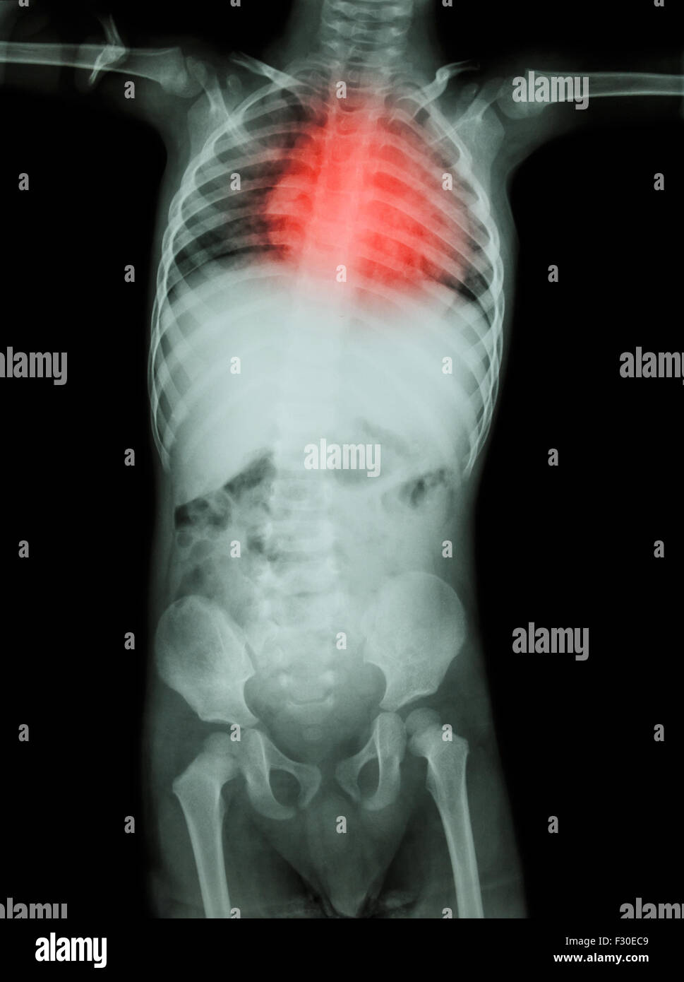 Rheumatic heart disease , Valvular heart disease ( Film xray body of