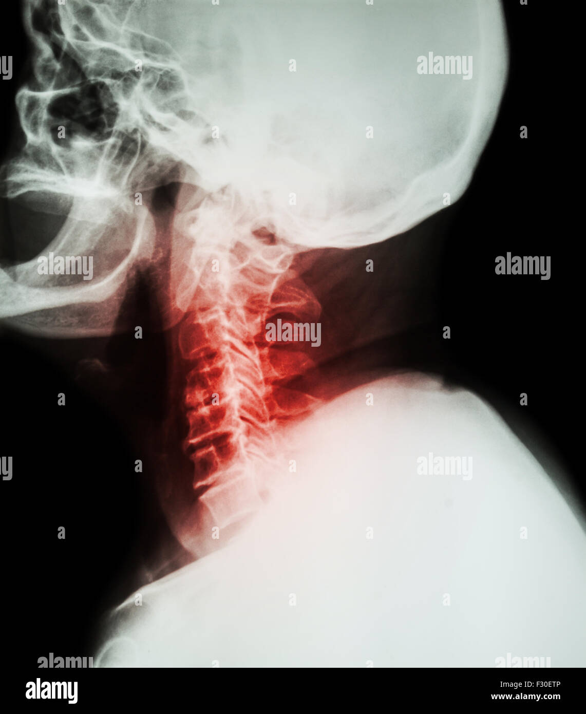 Cervical spondylosis .  Film x-ray of cervical spine ( lateral position ) ( side view ) Stock Photo