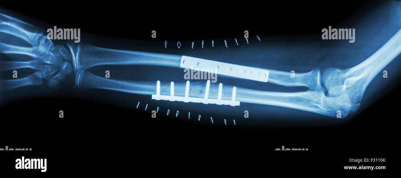 Fracture both bone of forearm ( ulnar and radius ) . It was operated ...
