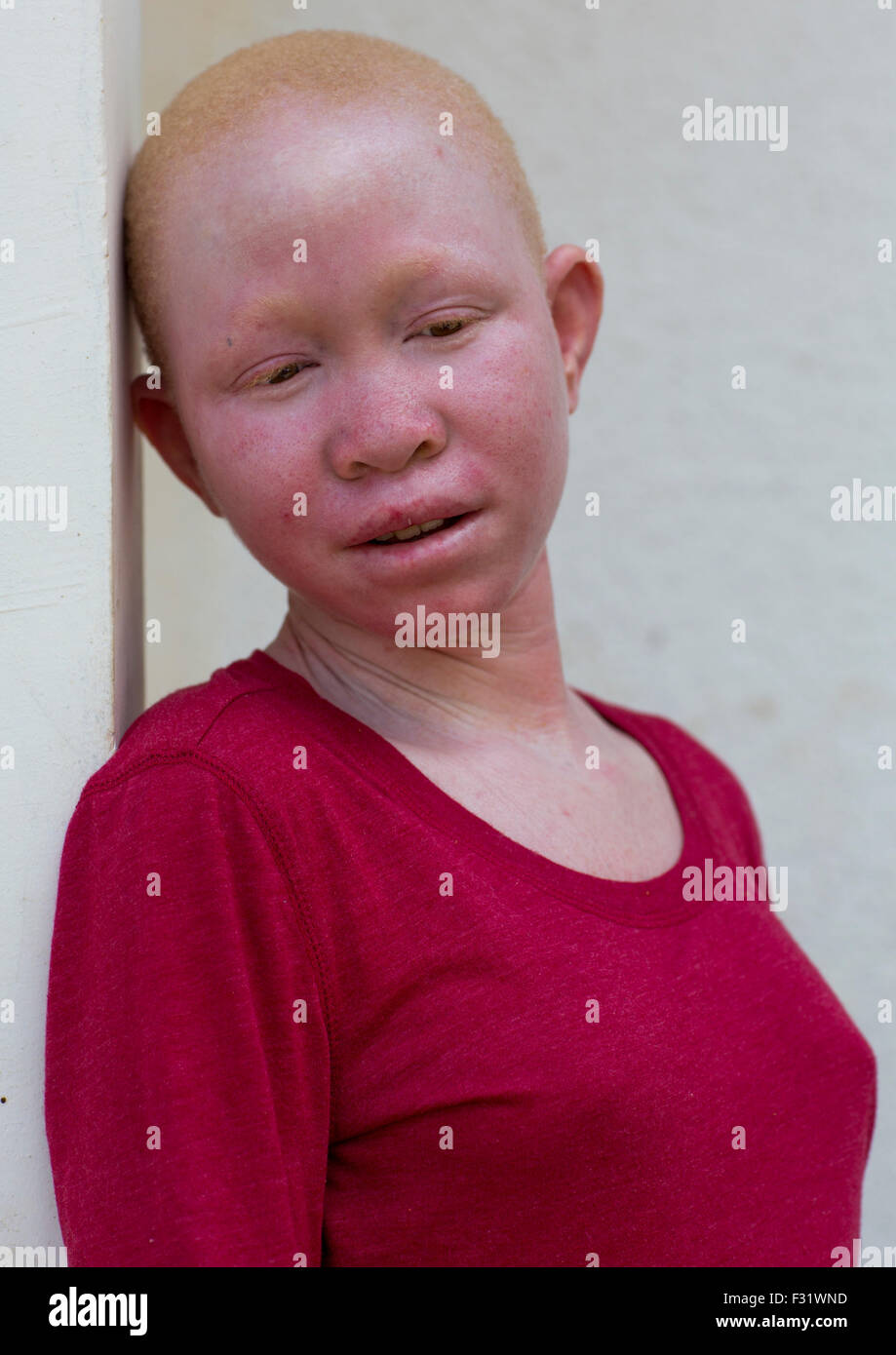Albino human africa hi-res stock photography and images - Alamy
