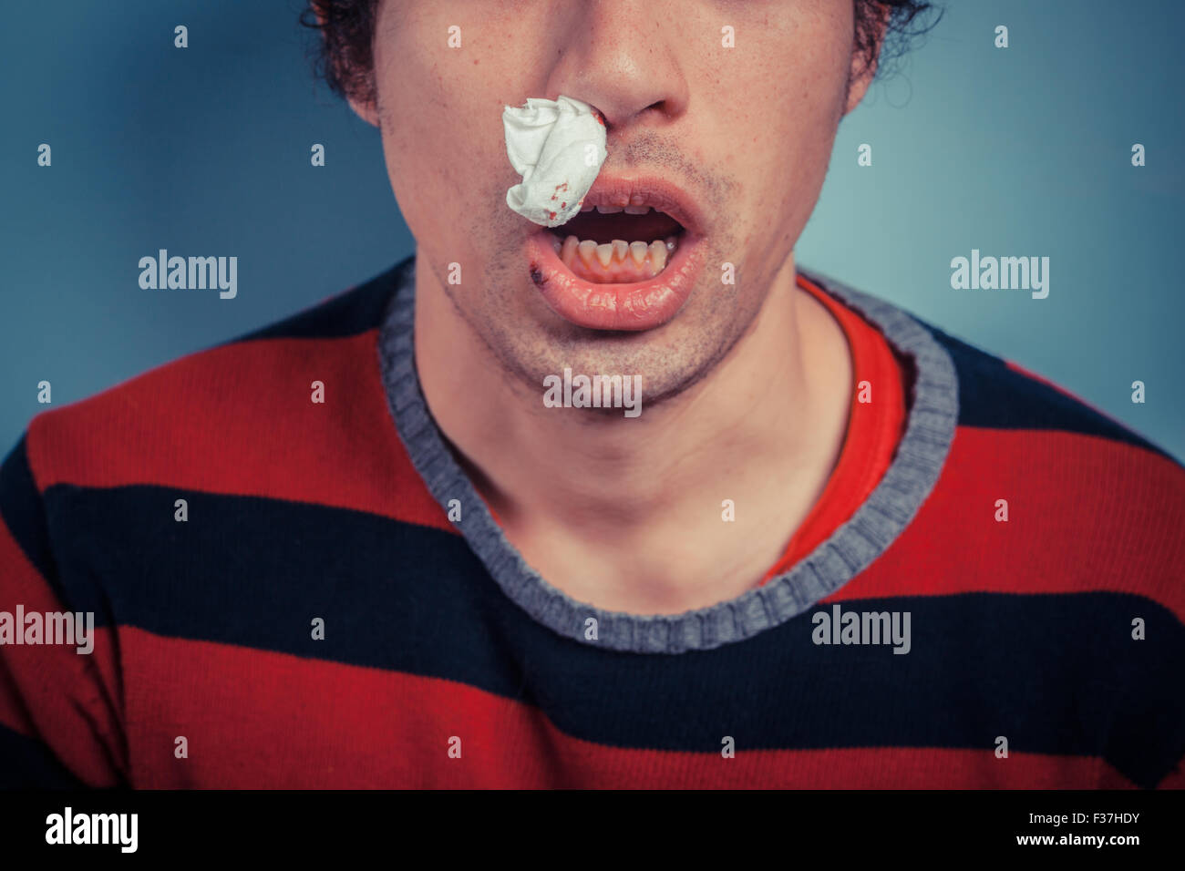 Young man with tissue in his nostril has nose bleed as well as cold sores on his lip Stock Photo