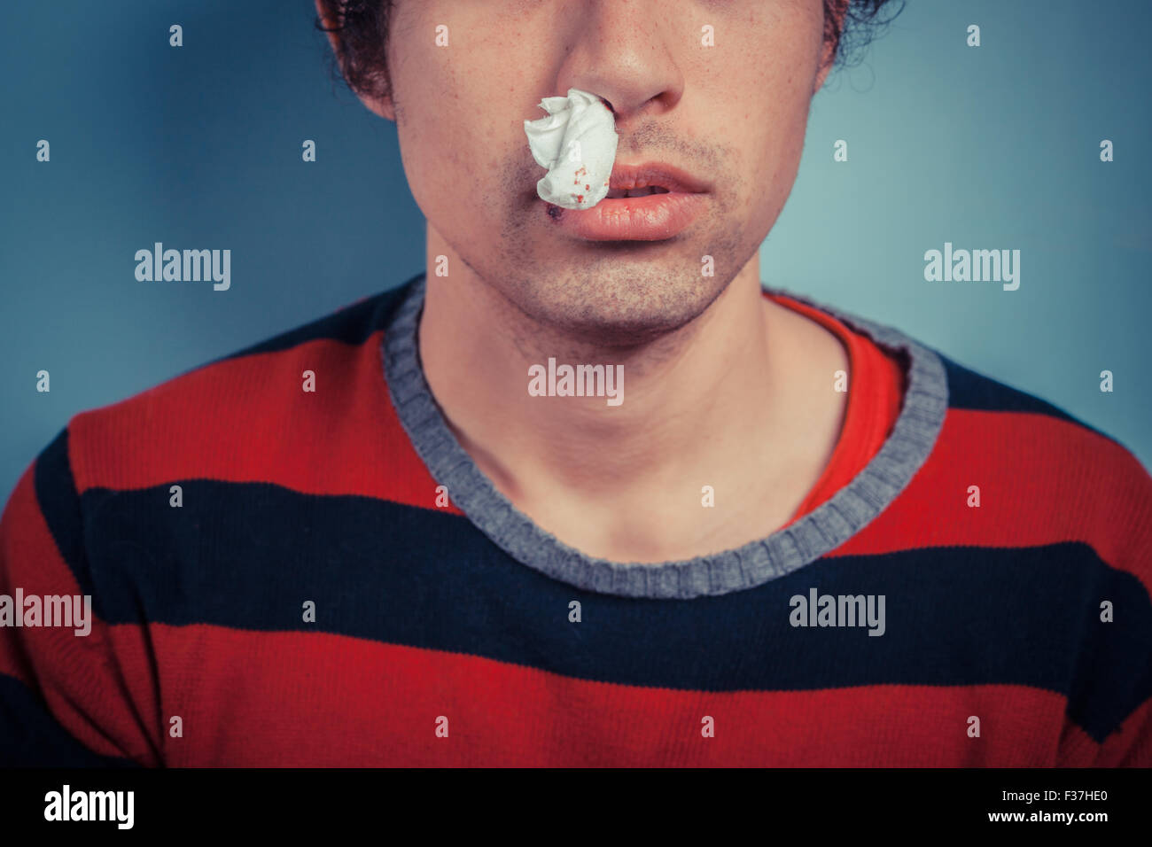 Young man with tissue in his nostril has nose bleed as well as cold sores on his lip Stock Photo