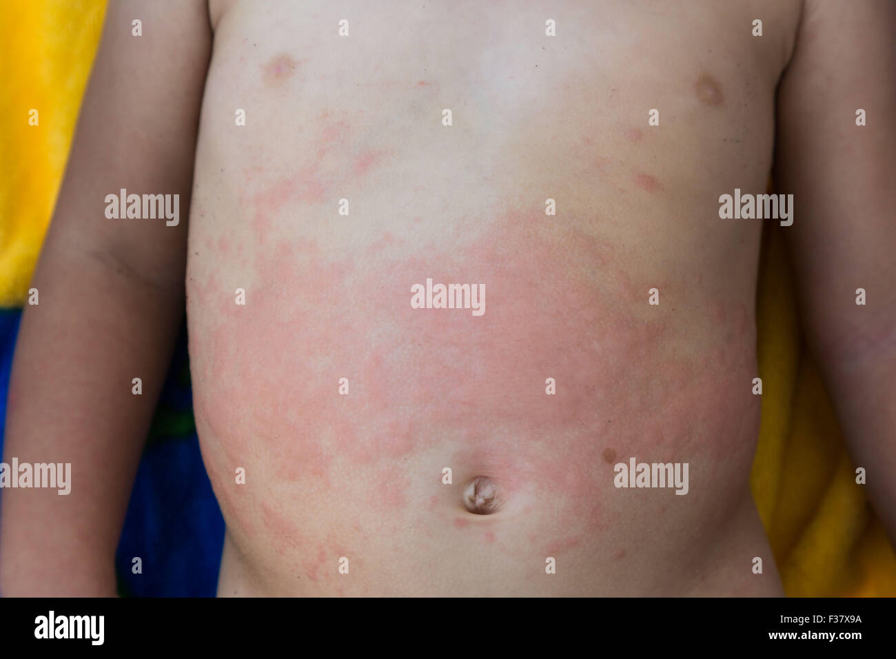 Rash from allergy on the torse of a 2 year old baby. Stock Photo