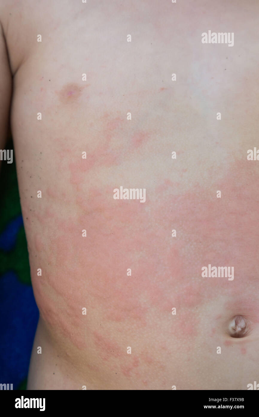 Rash from allergy on the torse of a 2 year old baby. Stock Photo
