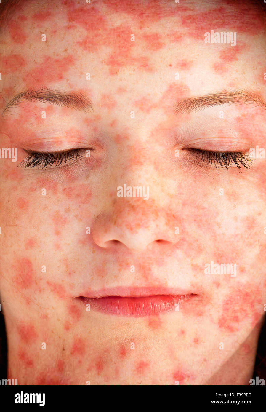 Young woman with skin rash Stock Photo