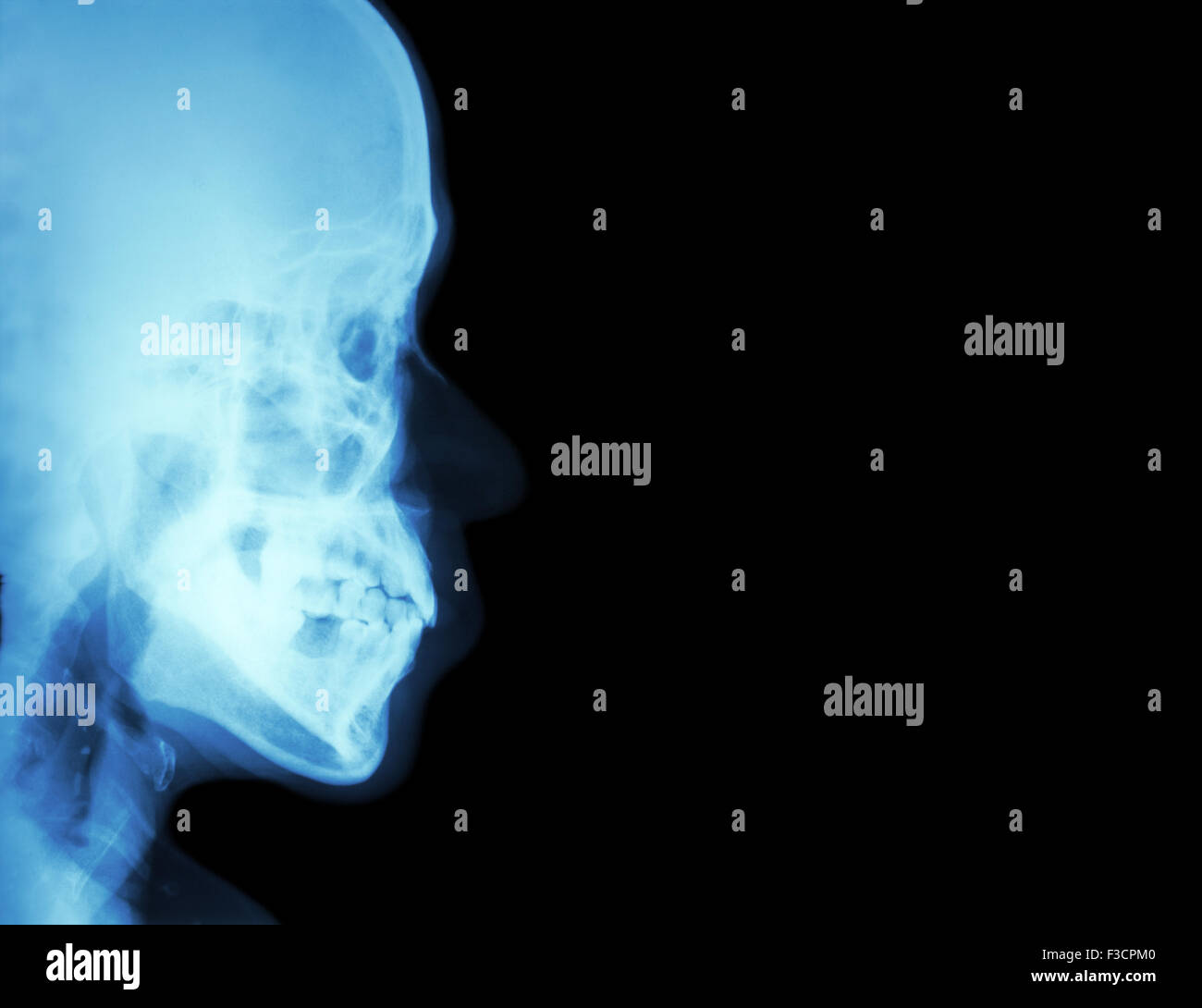 Film Xray lateral nasal bone ( side view of skull ) and blank area at