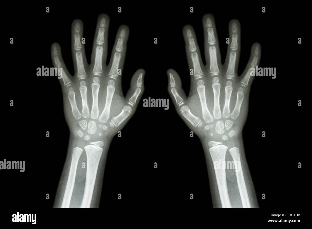 X Ray Normal Hand High Resolution Stock Photography and Images Alamy