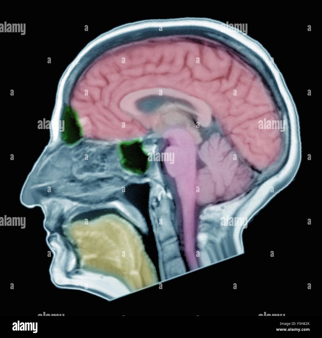 Brain MRI of adult male, normal structures Stock Photo