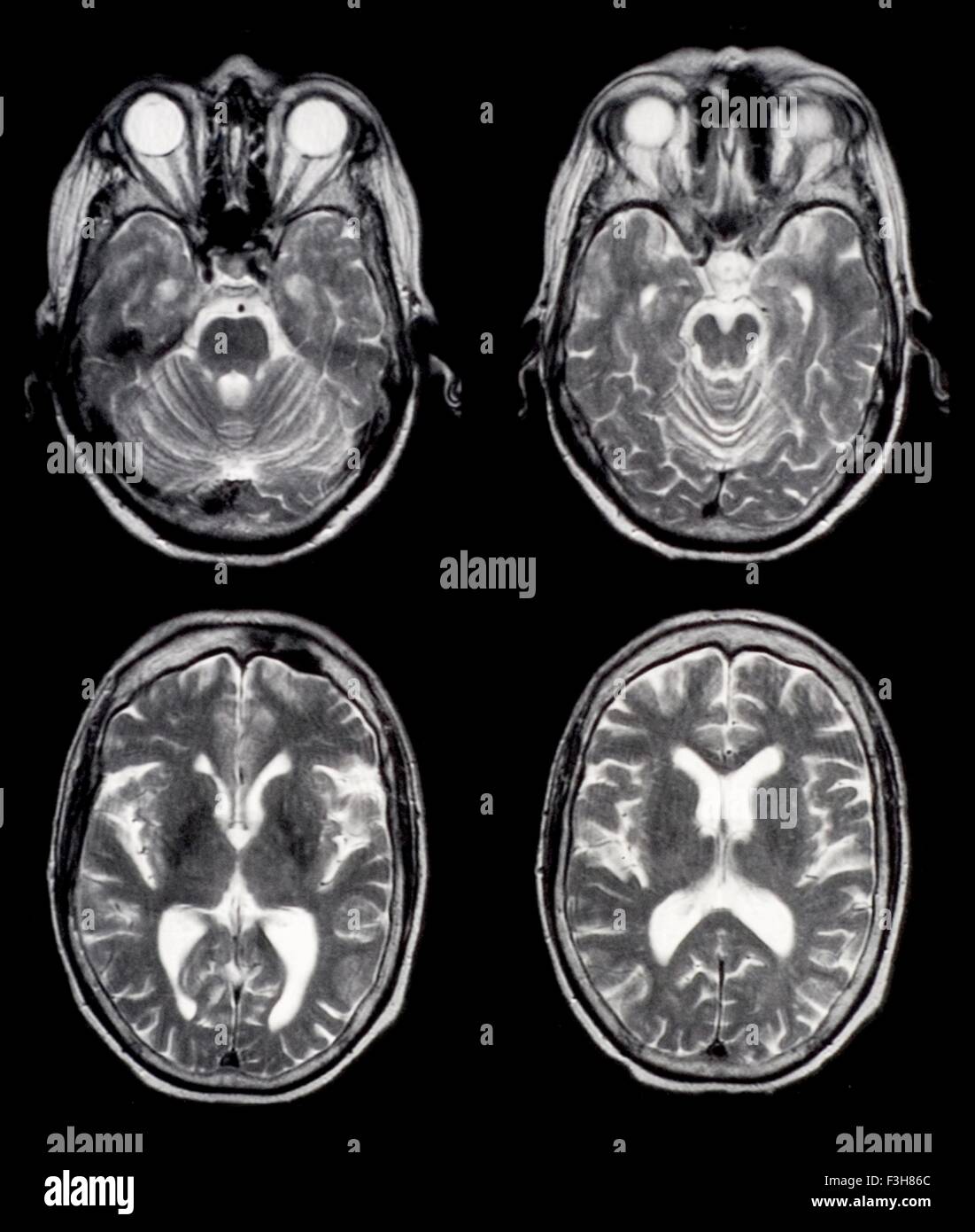 Axial brain MRI images Stock Photo