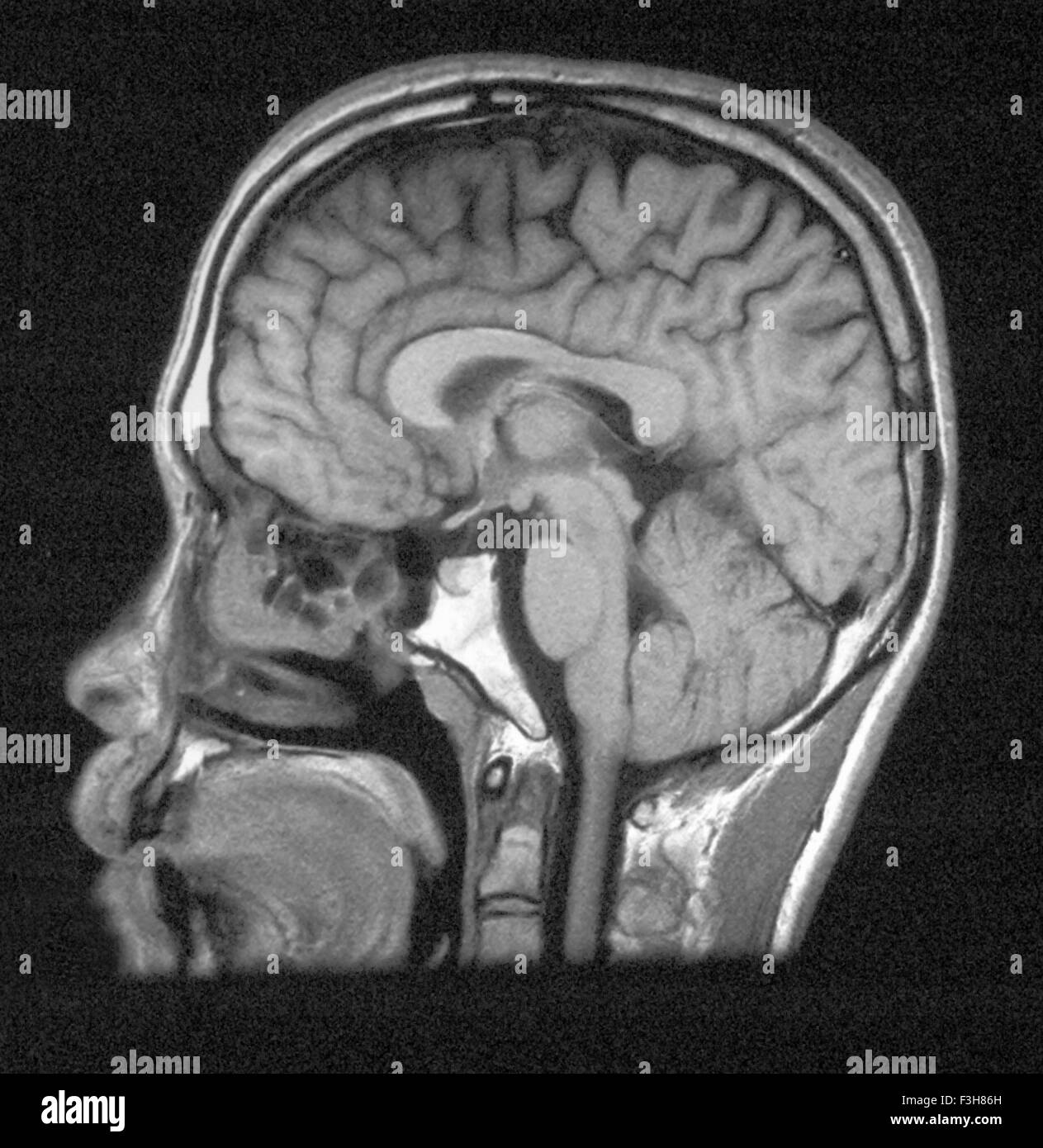 MRI of head showing normal brain structures Stock Photo
