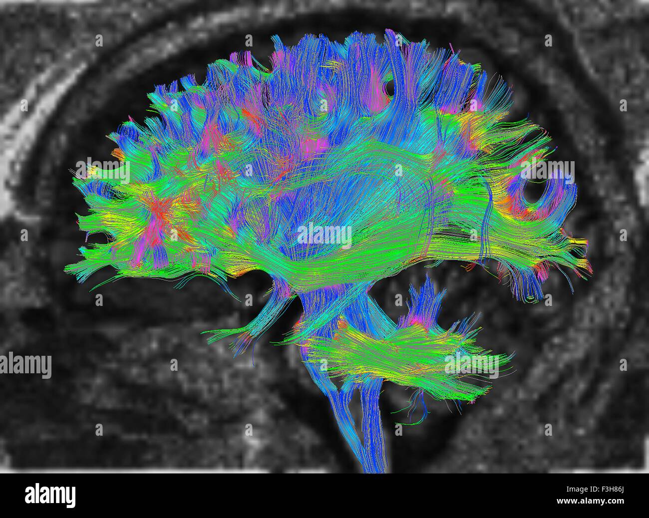 Diffusion MRI, also referred to as diffusion tensor imaging or DTI, of the human brain Stock Photo