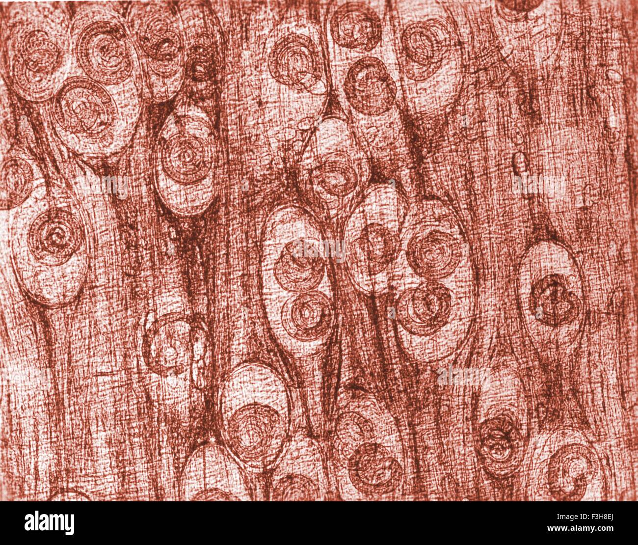 Photomicrograph of Trichinella spiralis cysts seen embedded in a muscle tissue specimen, in a case of trichinellosis Stock Photo