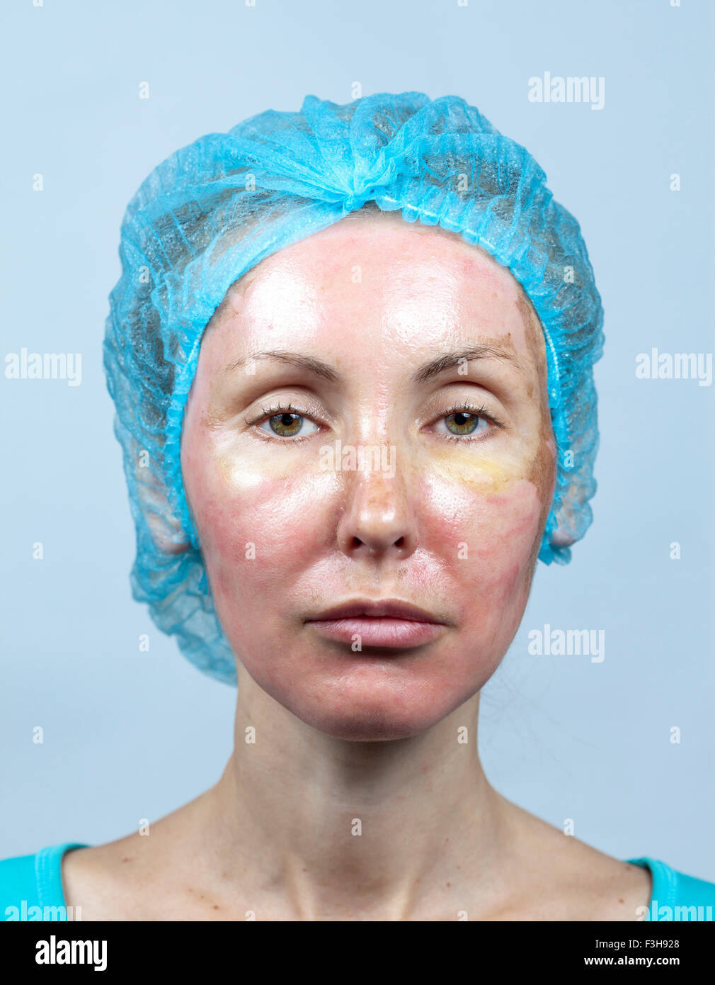 Cosmetology. New skin after a chemical peeling, a redness because of too fast deleting an old layer. Stock Photo