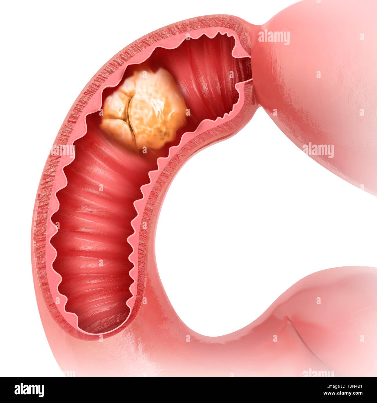 Small intestine with tumor, illustration Stock Photo