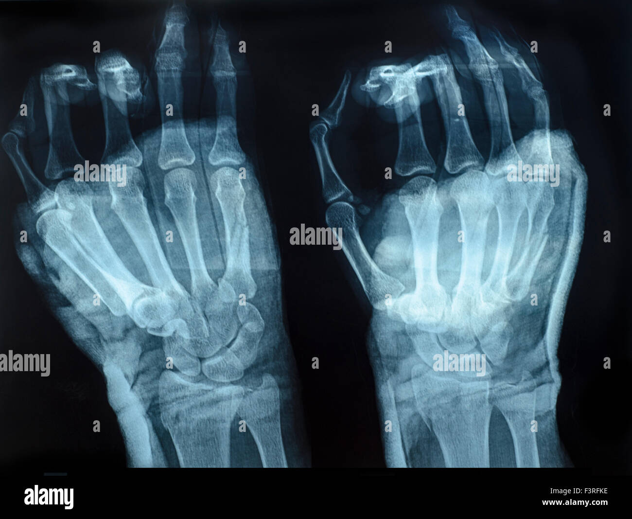 X Ray Normal Hand High Resolution Stock Photography And Images Alamy