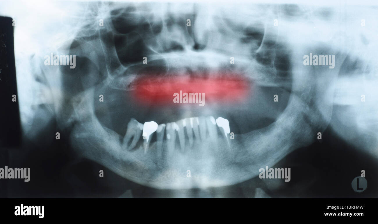Panoramic dental x-ray of an old person with some lower teeth and no tooth of the upper shown red. Selection Stock Photo