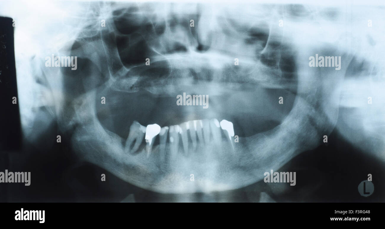 Panoramic dental x-ray of an old person with some lower teeth and no tooth of the upper. No selections Stock Photo
