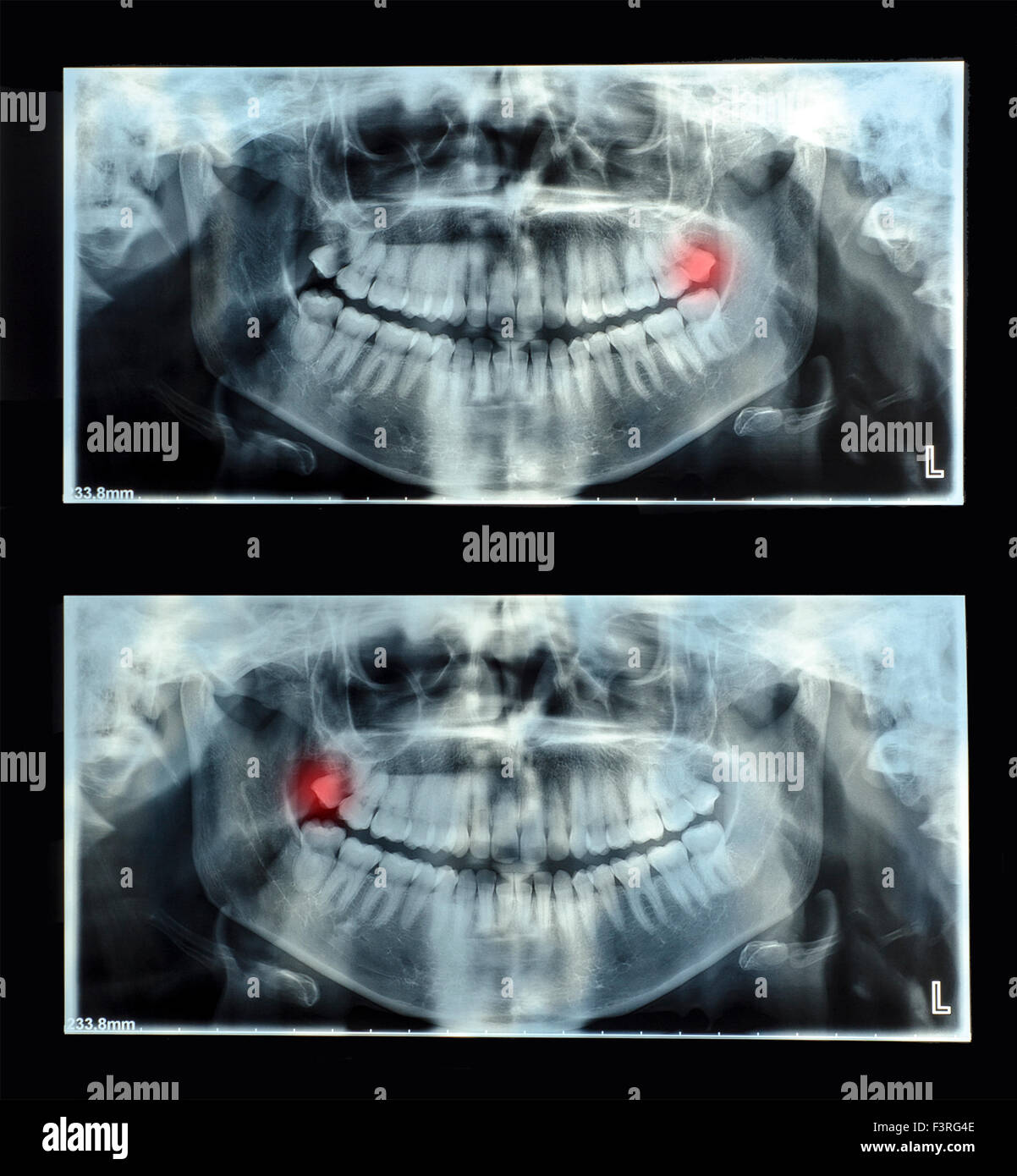 Panoramic dental x-ray  with superior upper wisdom tooth (eight tooth) shown red. Double x-ray Stock Photo