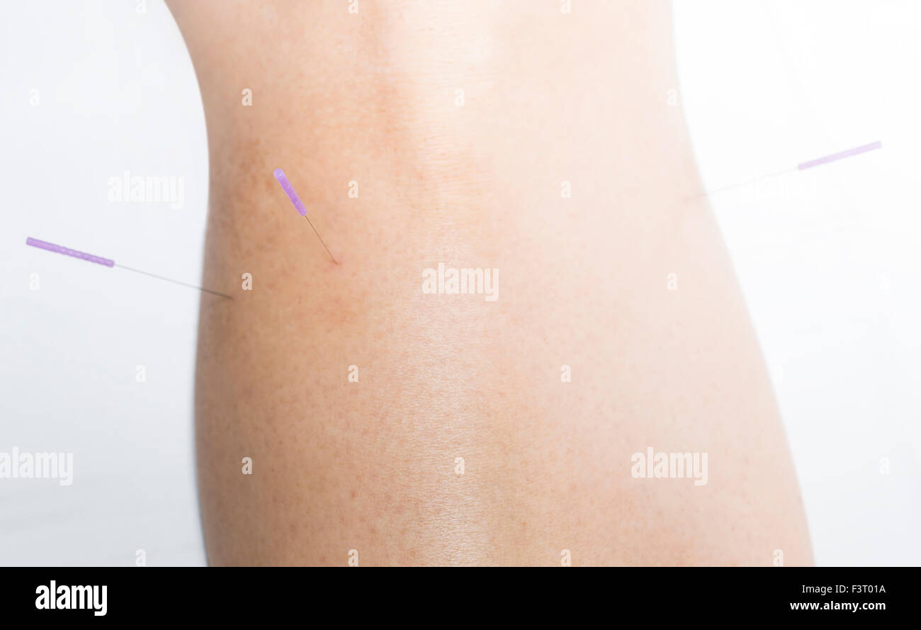 Acupuncture needle, pinched through the skin for alternative therapy. Stock Photo