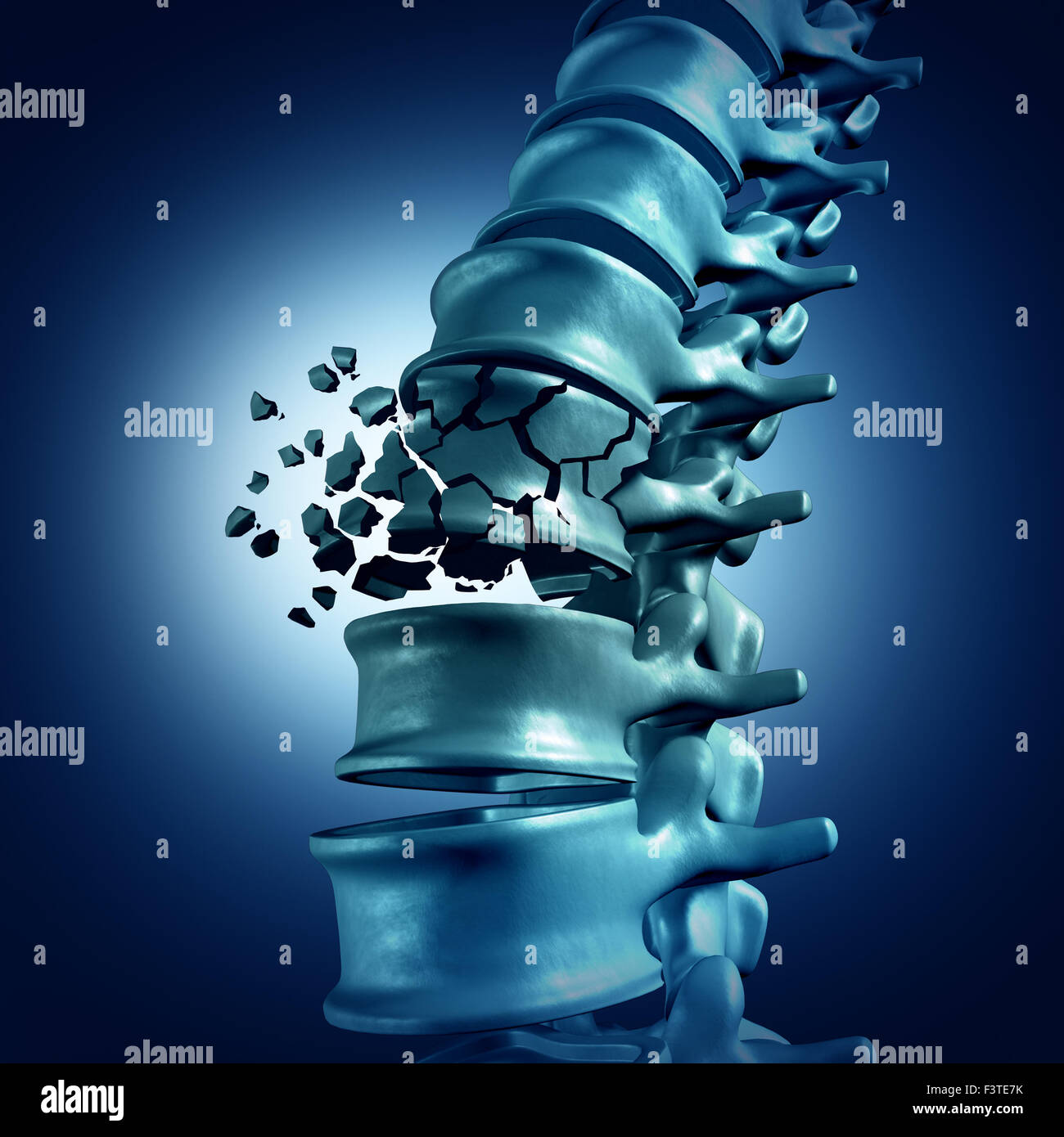 Spinal Fracture and traumatic vertebral injury medical concept as a human anatomy spinal column with a broken burst vertebra due to compression or other osteoporosis back disease. Stock Photo