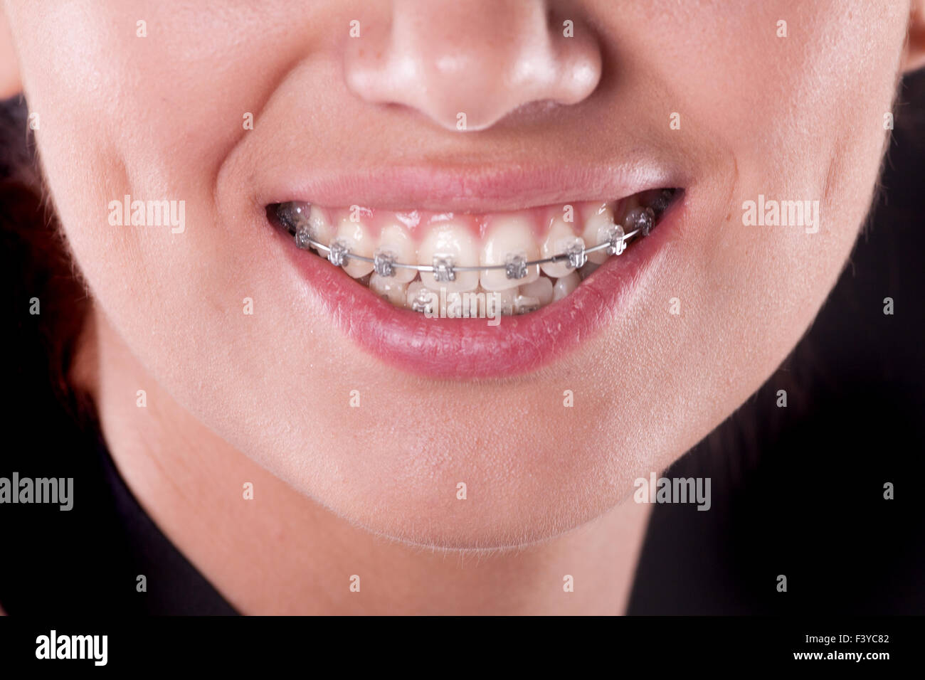 teeth with braces, close up Stock Photo Alamy