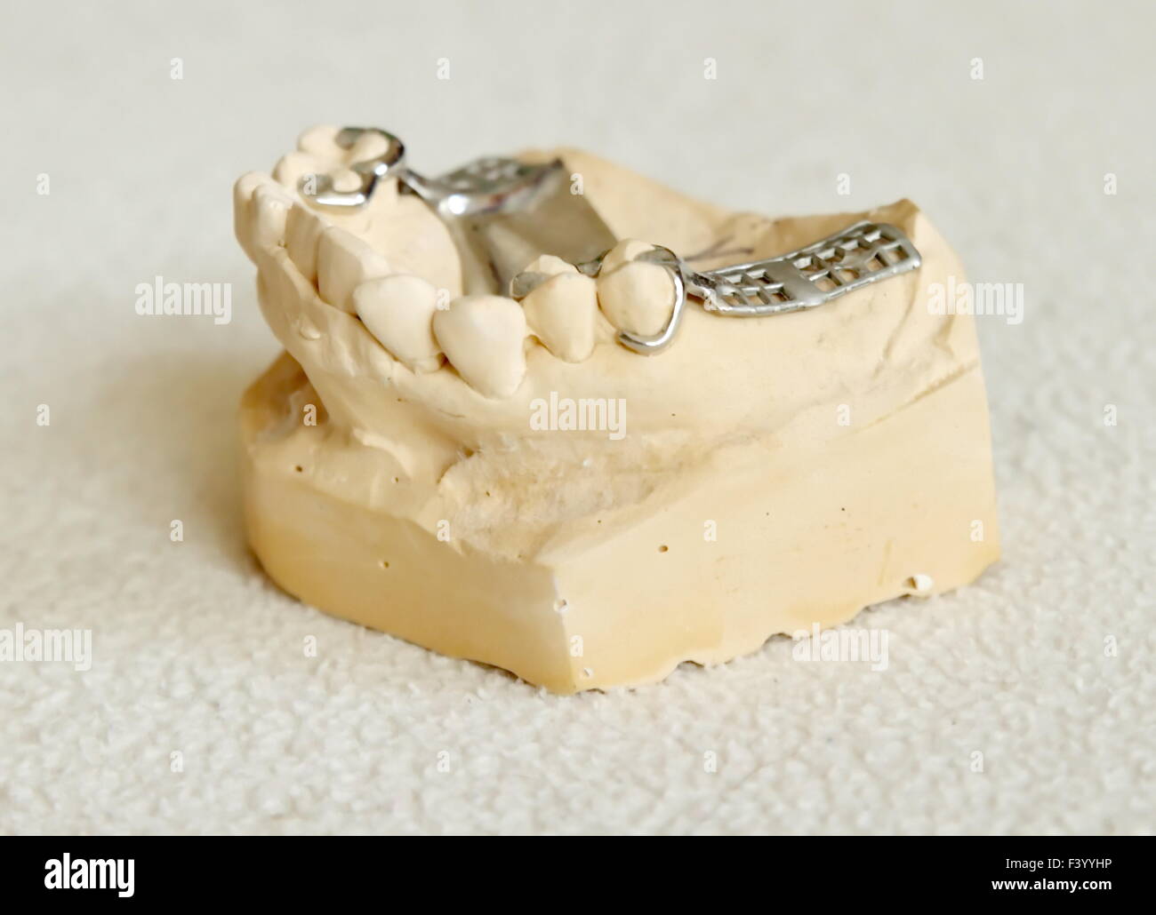 Metal framework for partial denture Stock Photo Alamy