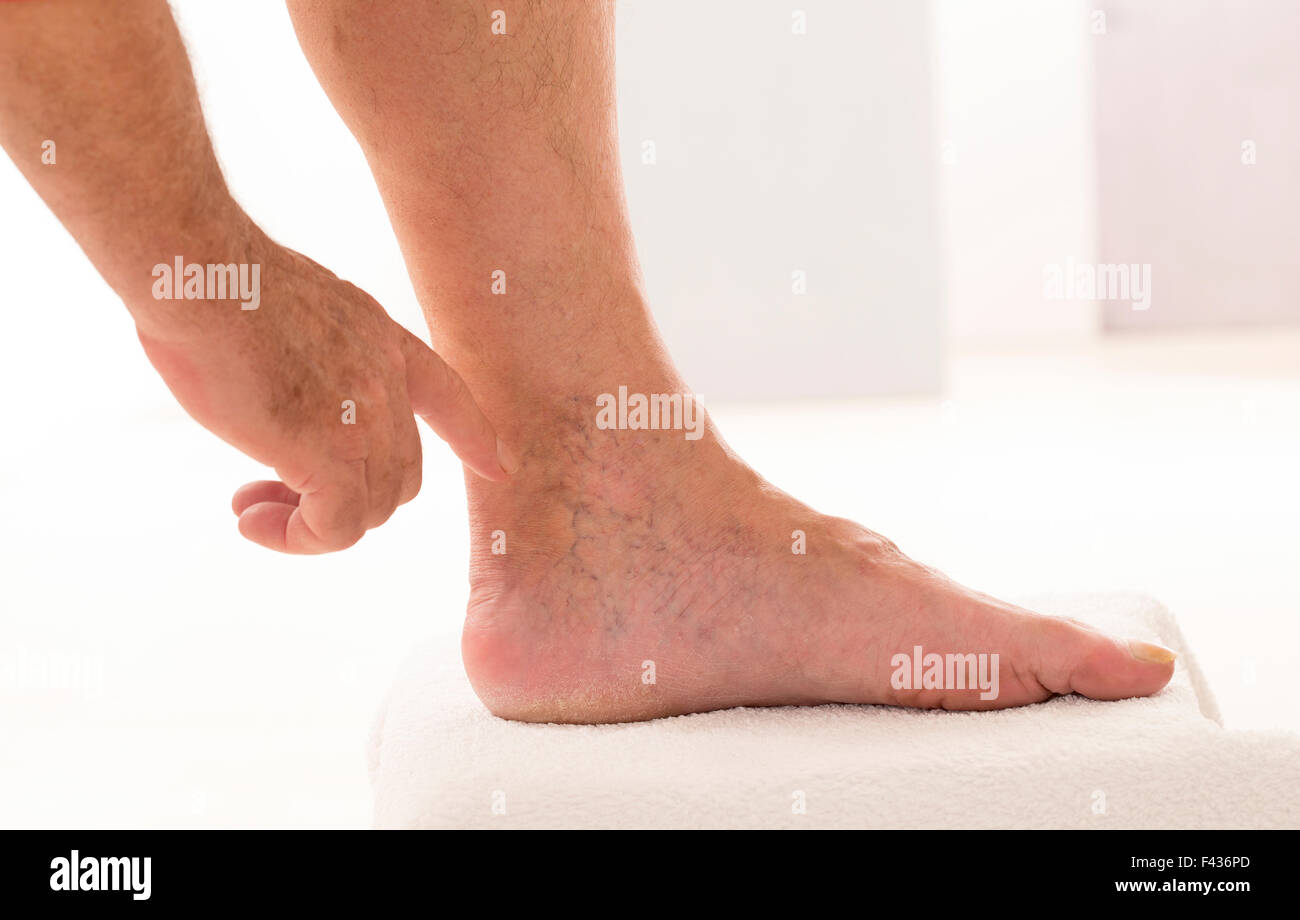 Varicose veins Stock Photo