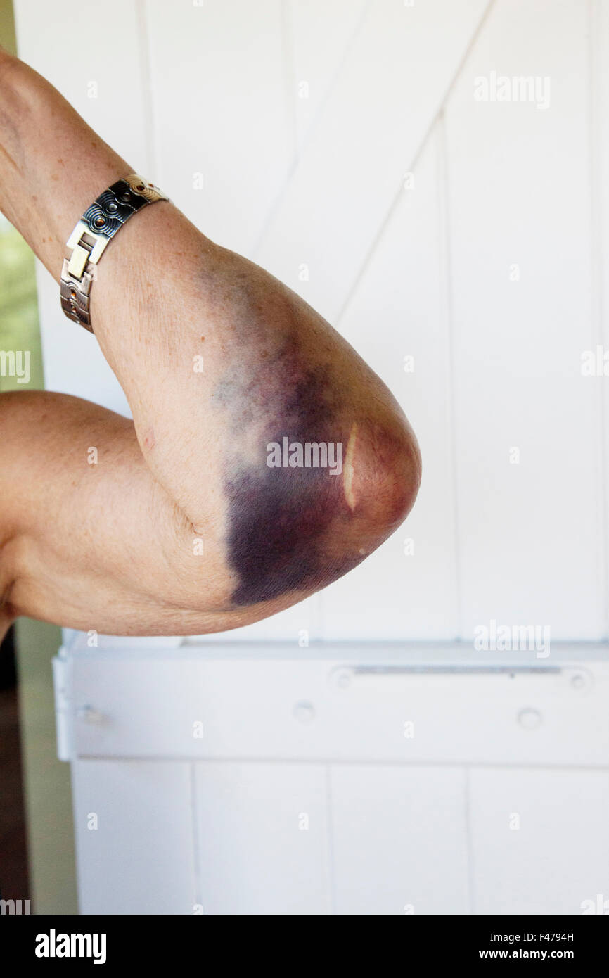 Hematoma arm hires stock photography and images Alamy