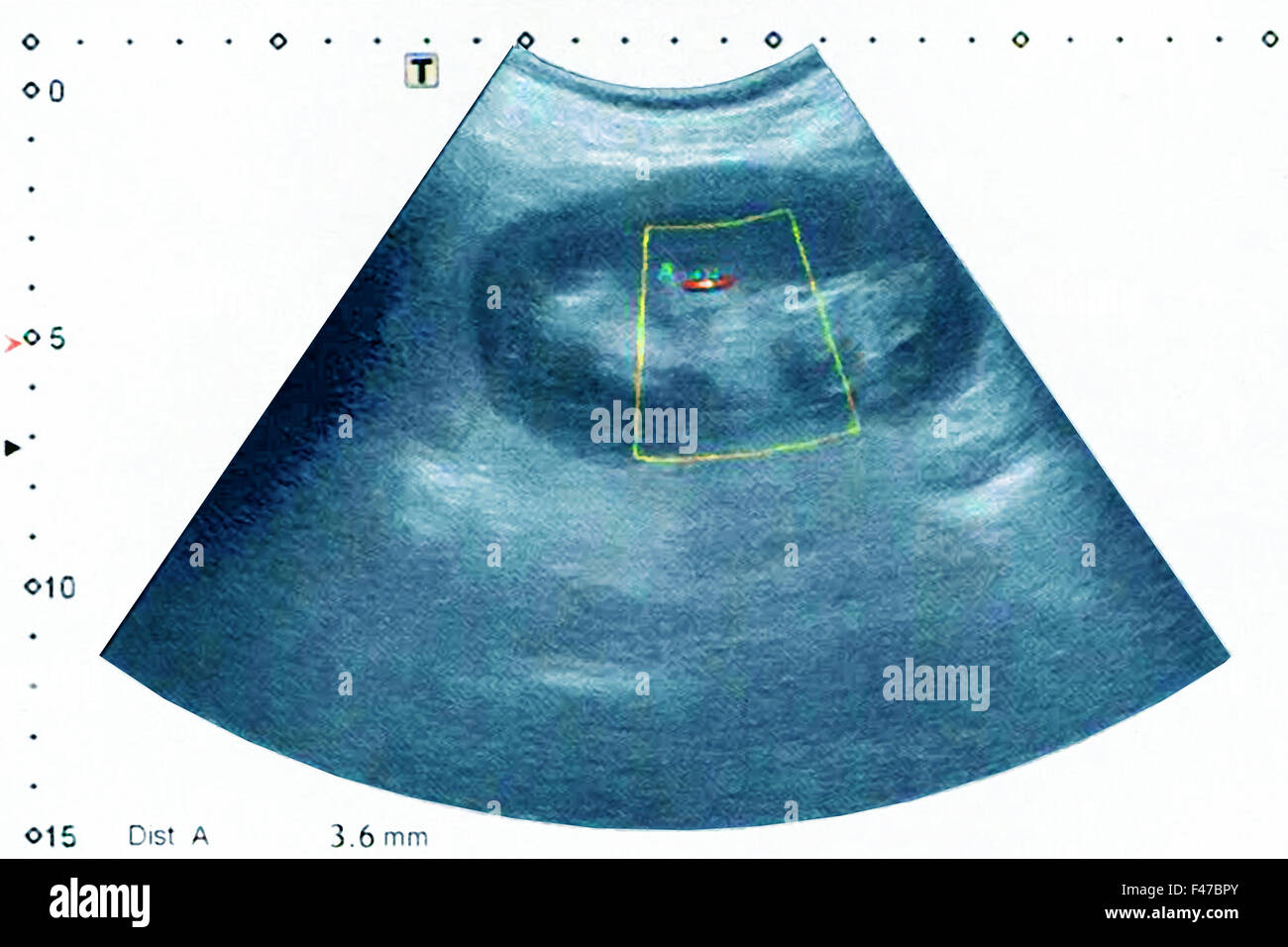 Lithiasis hires stock photography and images Alamy