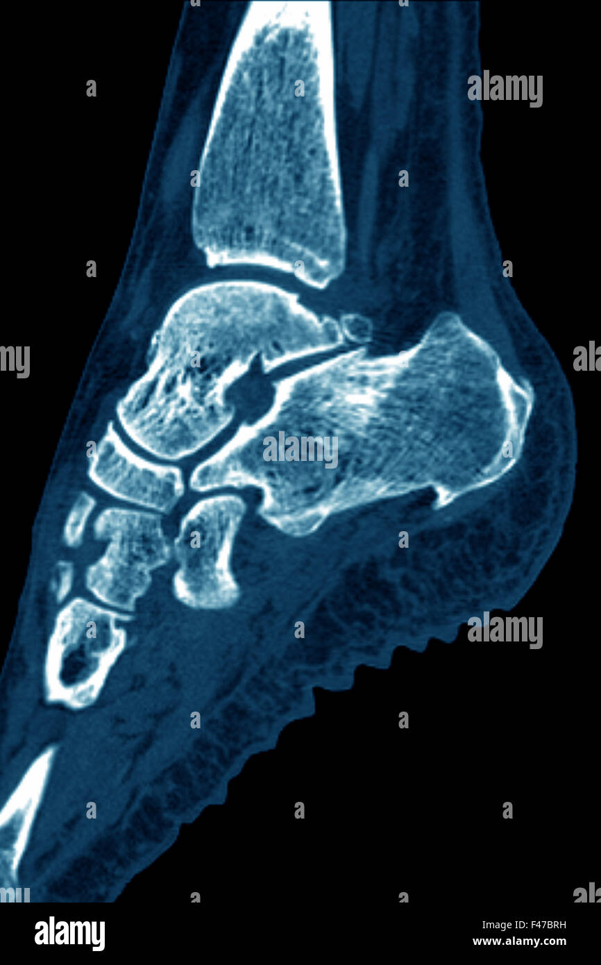 ENTHESOPATHY CT SCAN Stock Photo