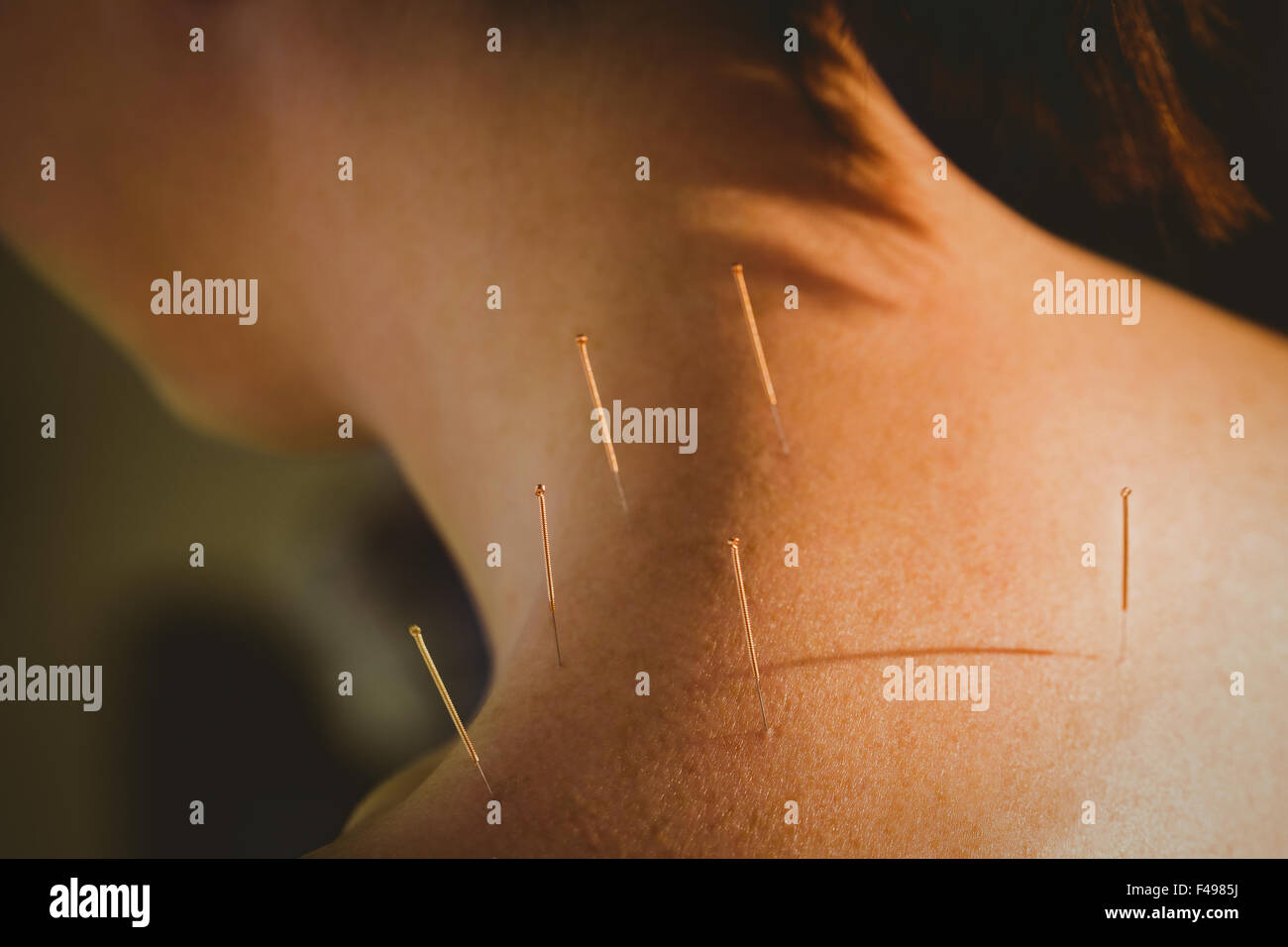 Young woman getting acupuncture treatment Stock Photo Alamy