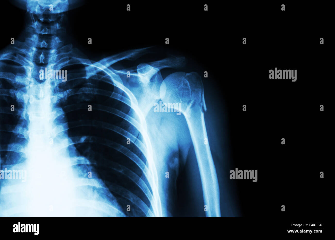 Fracture at neck of humerus ( arm bone ) ( film x-ray left shoulder and blank area at right side ) Stock Photo