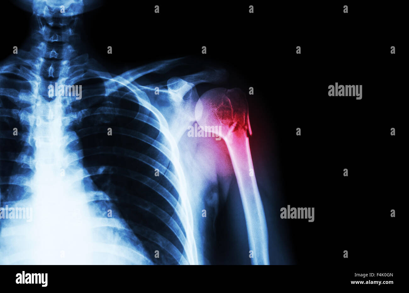 Fracture at neck of humerus ( arm bone ) ( film x-ray left shoulder and blank area at right side ) Stock Photo