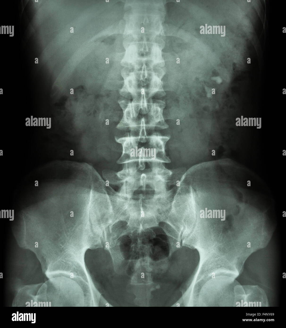 gabapentin renal calculi