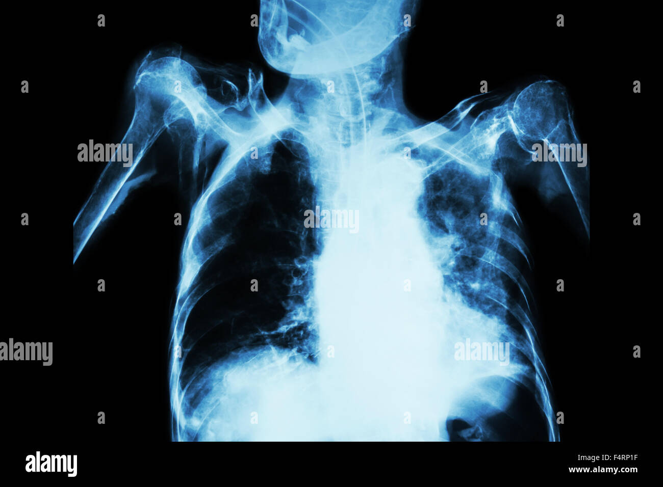 Pulmonary Tuberculosis with acute respiratory failure ( Film chest x