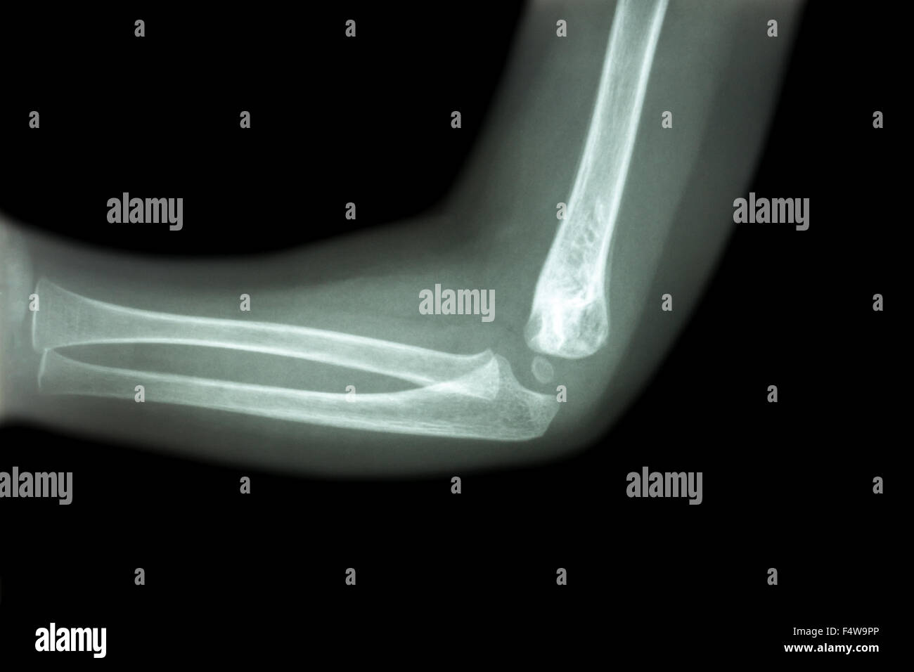 Film x-ray of child 's elbow ( normal child 's elbow ) ( Side view , Lateral ) Stock Photo