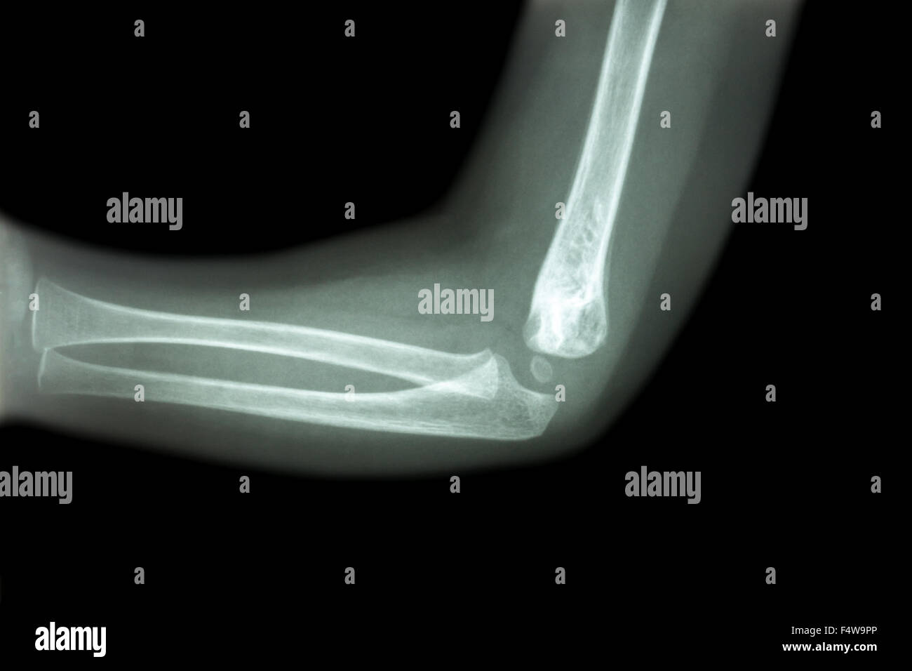 Xray Elbow Xray Elbow
