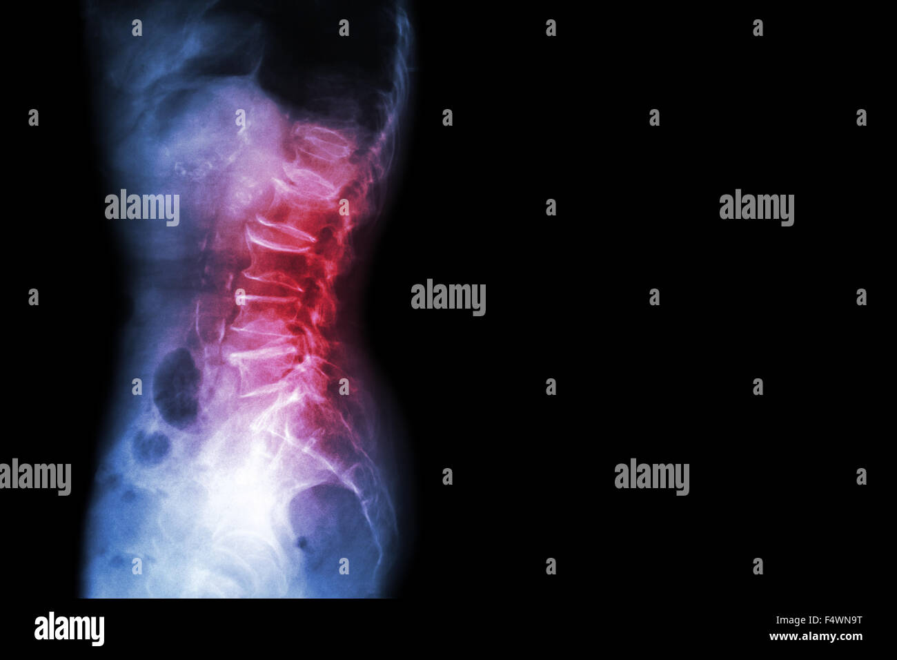 Spondylosis , Spondylolisthesis  ( Film x-ray lumbo - sacral spine show spine collapse , decrease in disc space , bony spur form Stock Photo