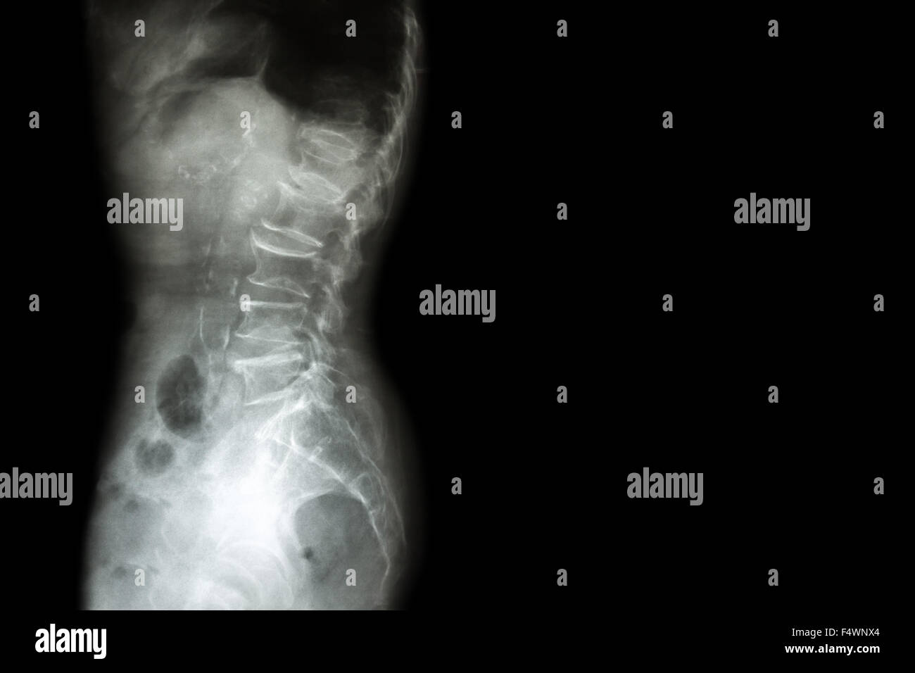 Spondylosis , Spondylolisthesis  ( Film x-ray lumbo - sacral spine show spine collapse , decrease in disc space , bony spur form Stock Photo