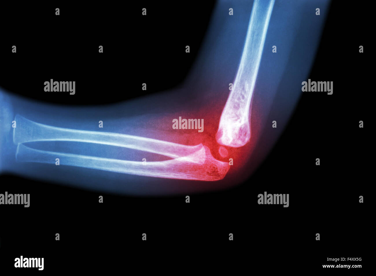 Rheumatoid arthritis , Gouty arthritis ( film xray child 's elbow with arthritis at elbow