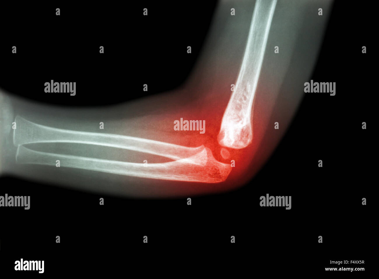 Rheumatoid arthritis , Gouty arthritis ( film xray child